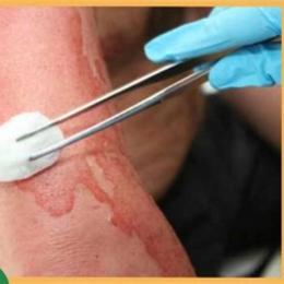 xử lý vết bỏng bị tróc da